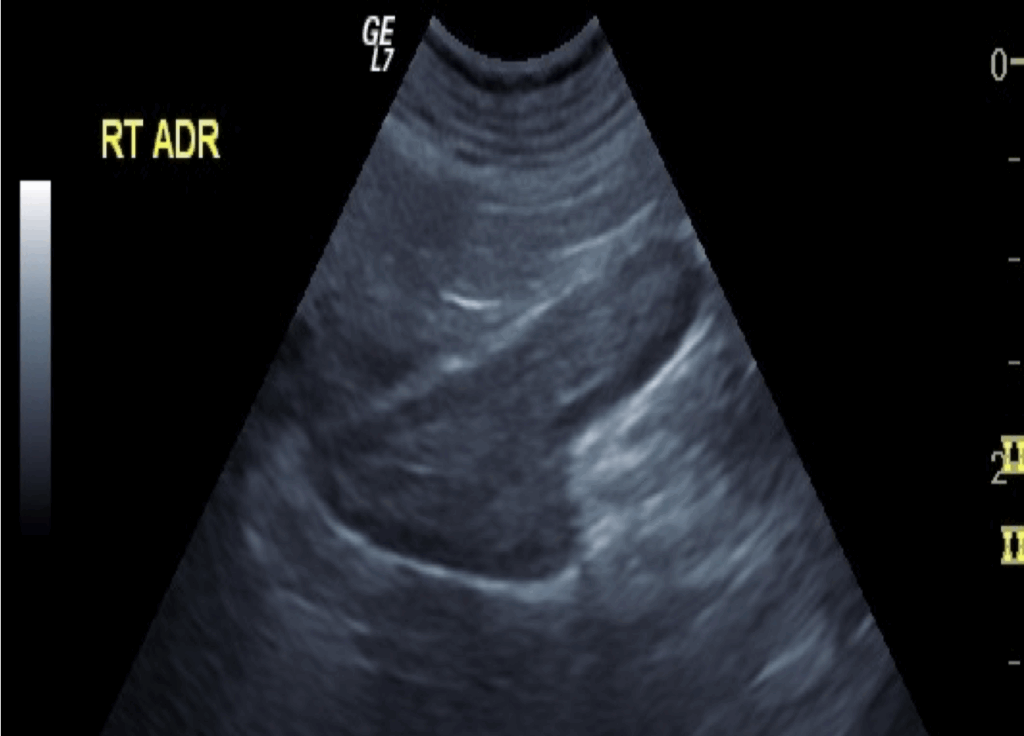 Magnified view of the right adrenal gland in canine patient e1765016628400