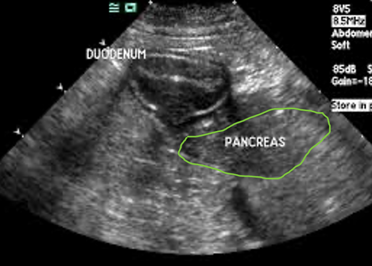 Step 8 The short axis section of the right limb of pancreas seen medial and lateral to the descending duodenum